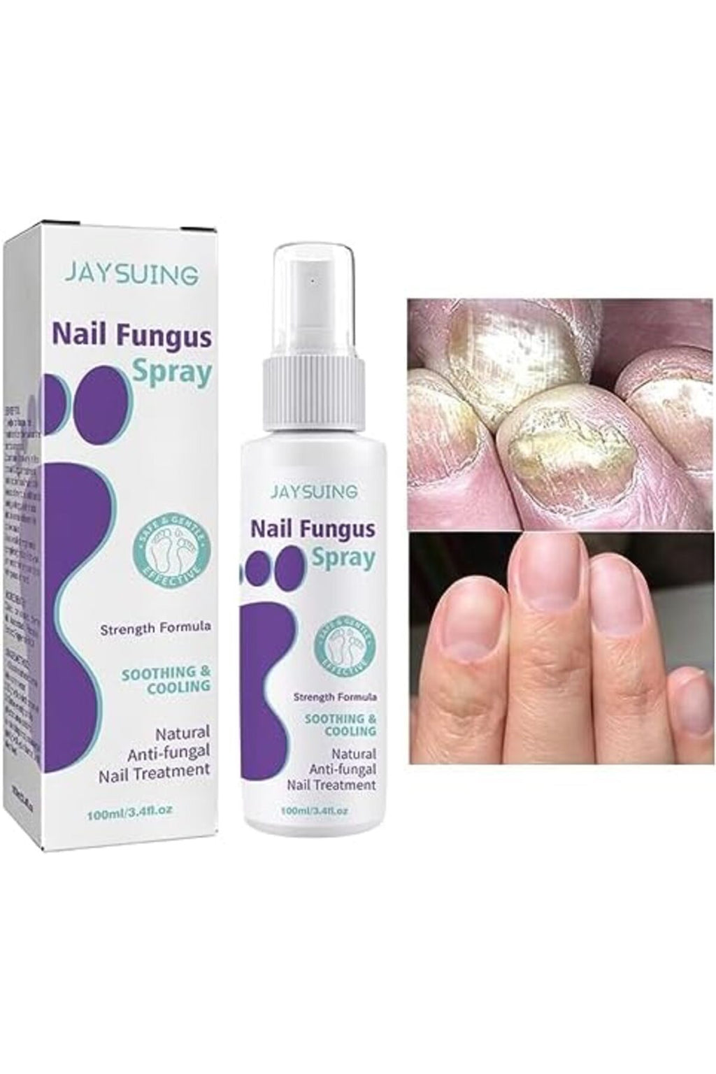 Say Goodbye to Discolored Nails with Jaysuing™ Nail Fungus Spray