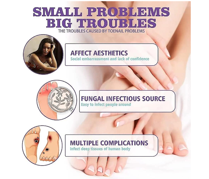 Say Goodbye to Discolored Nails with Jaysuing™ Nail Fungus Spray